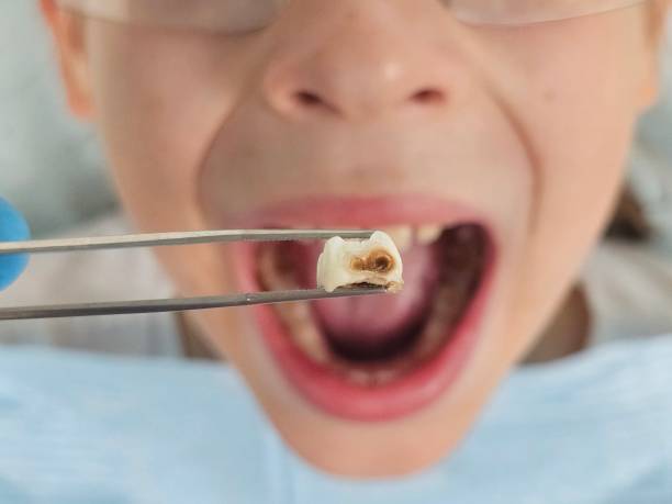 Best Emergency Wisdom Teeth Removal in Port Barrington, IL